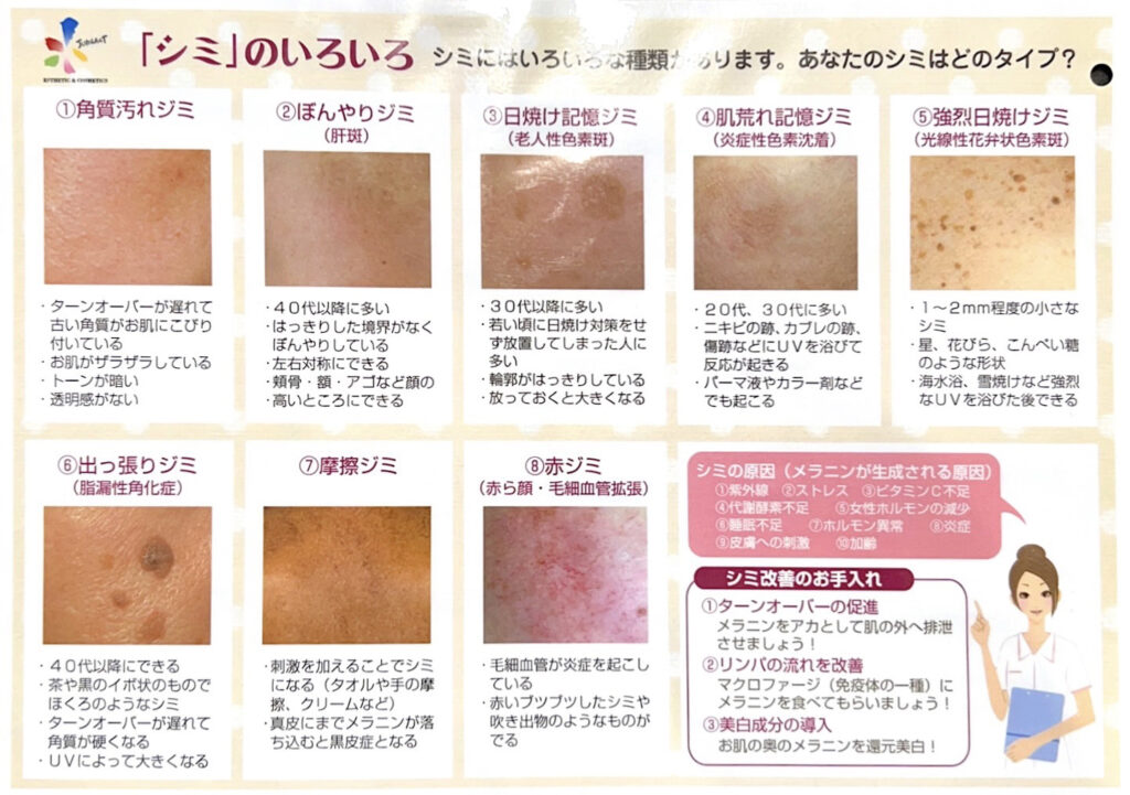 シミの種類と予防方法 | エステティック ジュビラン ブランシュ
